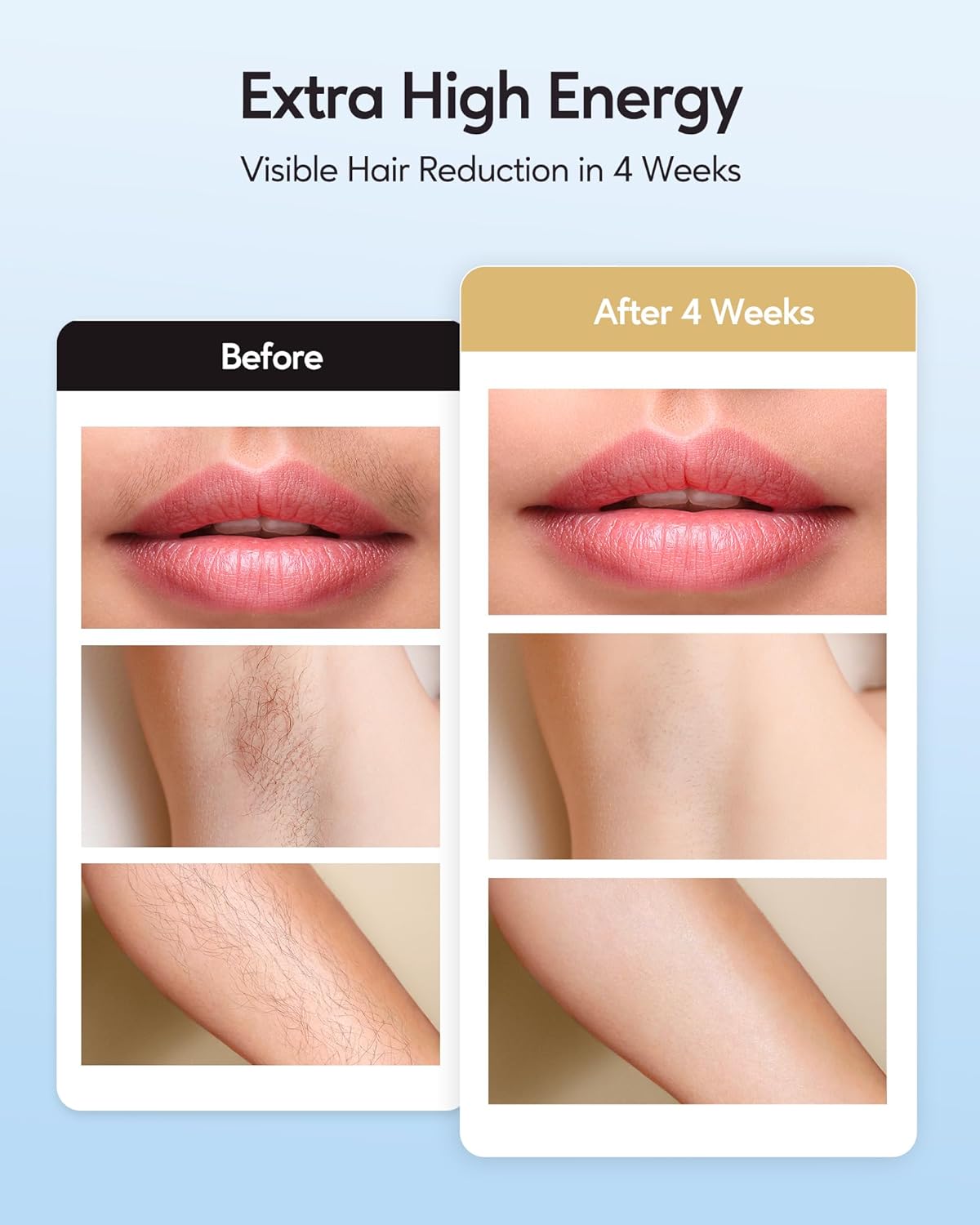 Laser Hair Removal with Ice Cooling Care Function